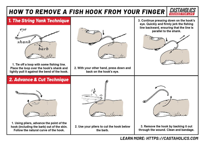 Removing A Fish Hook From Your Skin 9GAG