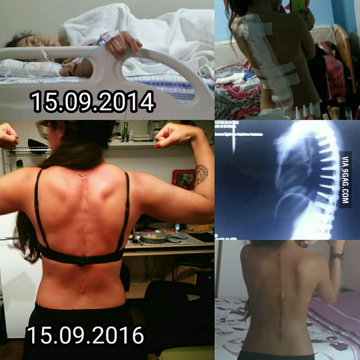 To the 9gag scoliosis warriors. Be strong and don't afraid of surgery. It has been 2 years since mine. I feel great!