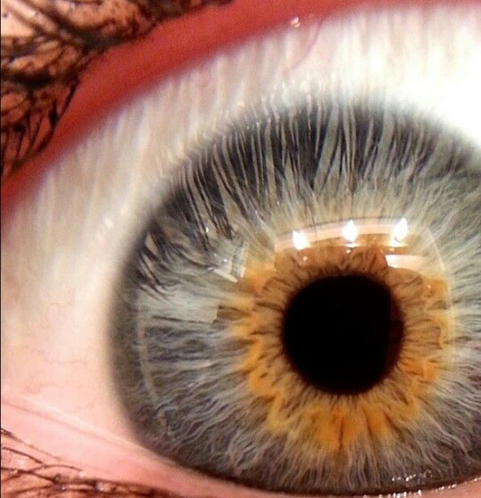Central heterochromia, aka The Sunflower Eye, when people have a shade