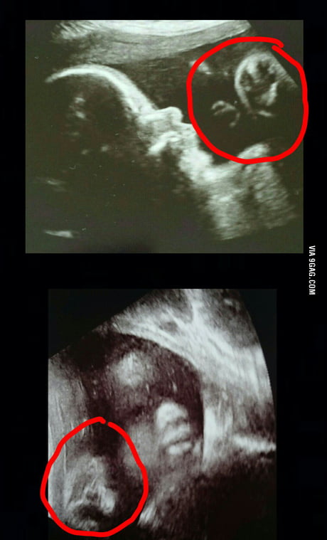 First ultrasound of my baby and noticed a ghostly image in it and thought  that's funny. Just had another taken. I'm no longer laughing - 9GAG