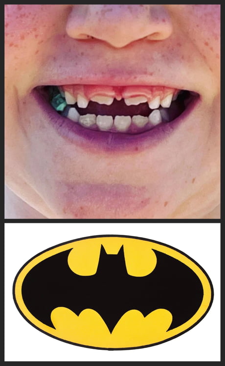 This 6yo teeth gap looks like Batman's logo 1988-2000 - 9GAG