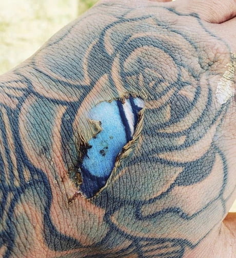 Epidermal burn of the hand exposes bright colors of tattoo ink embedded in  the dermal layer of the skin - 9GAG