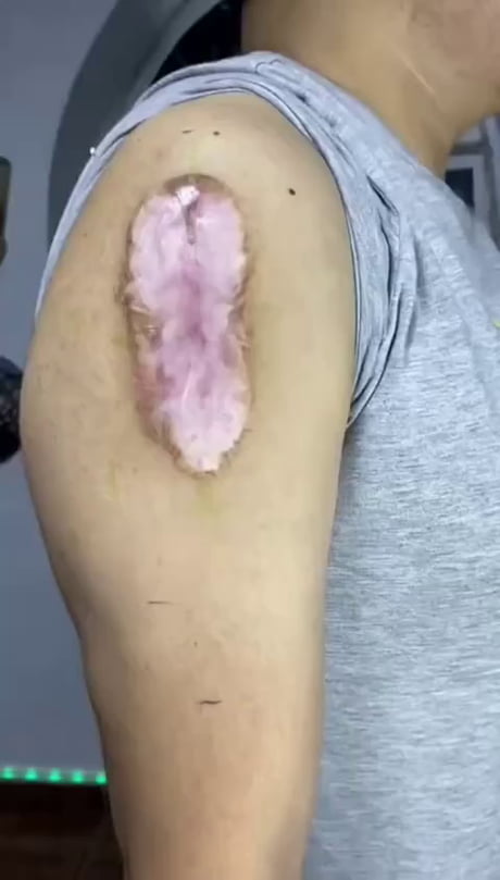 Tattoo over scar