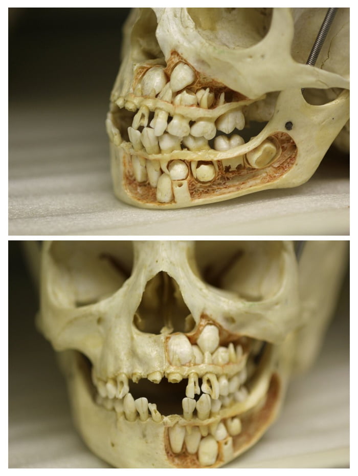 A child’s skull before they lose their baby teeth 9GAG