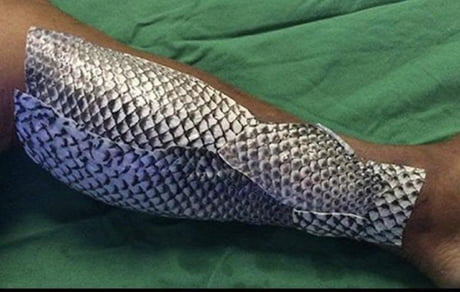 Doctors in Brazil are treating burn victims with fish skin. When ...