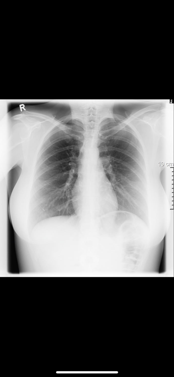 Breast implants under xrays 9GAG