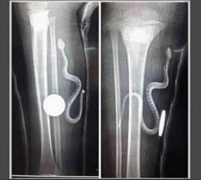 Reason for consultation: it itches under the cast