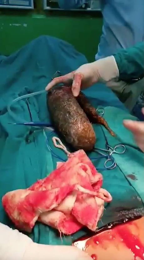 Doctors Remove 6.8kg Ball Of Hair From Girl s Stomach 9GAG