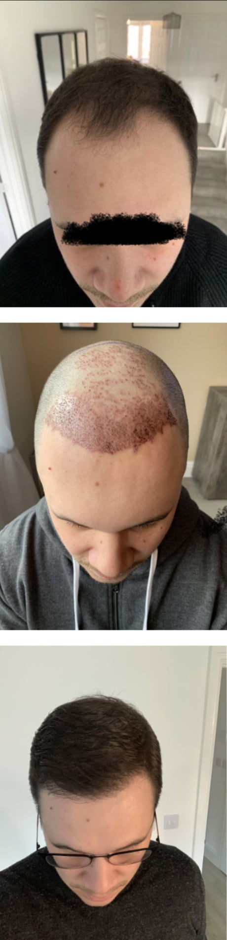 9 months ago I had a hair transplant and did a AMA. 'Hairs' a before,  during and after update - 9GAG