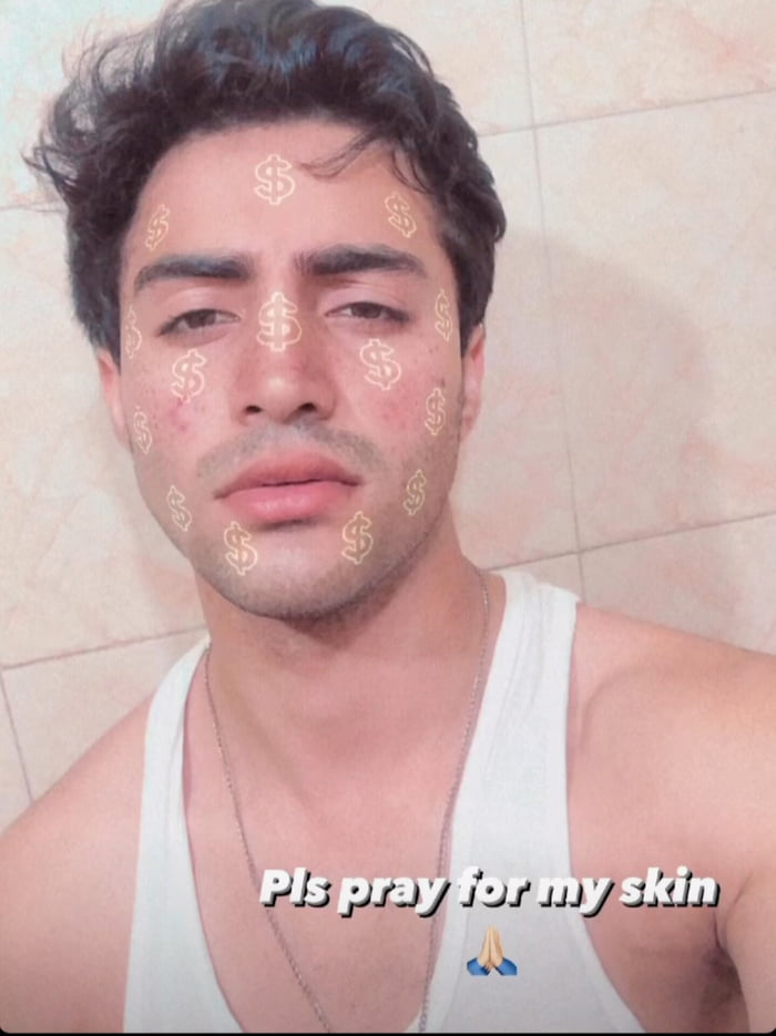 suggest-any-tips-to-get-rid-of-acne-9gag