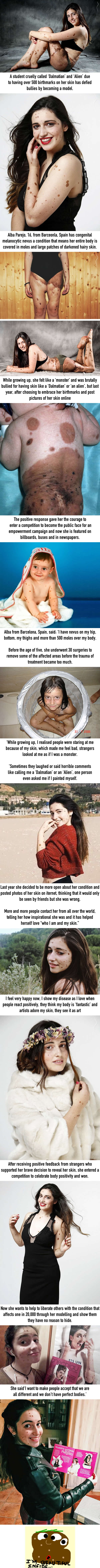 Student with 500 birthmarks who was branded a 'Dalmatian' and an 'alien' defies the bullies to become a MODEL.