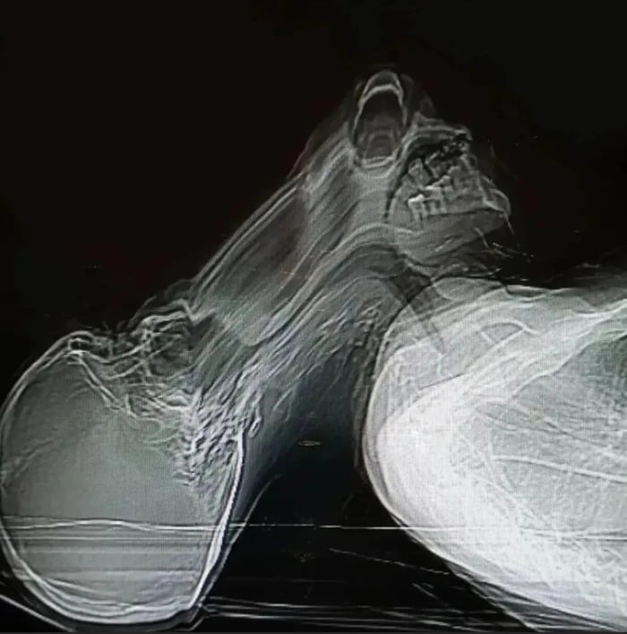 Claustrophobic patient decided to get up during a CT scan