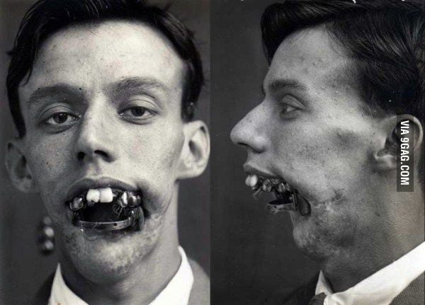 World War 1 Soldier With Lower Jaw Shot Off. - 9gag