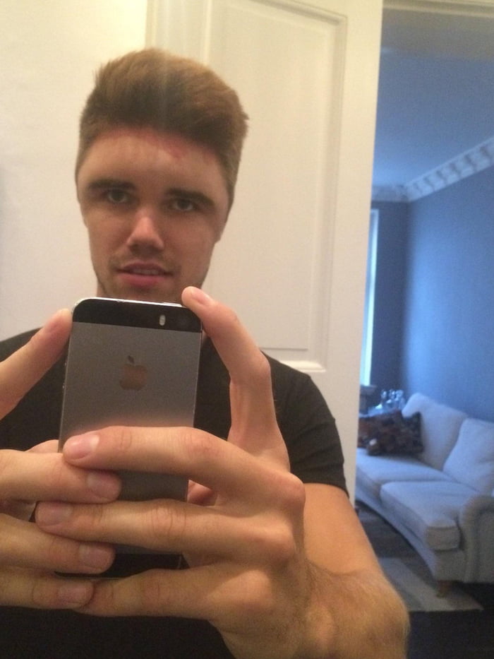 A hair dye allergy 9GAG