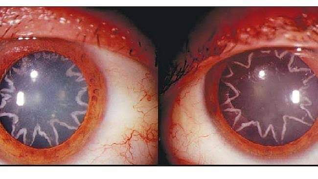 The eyes of an electrician after being zapped by 14,000 volts of electricity. His shoulder touched a live wire and the current passed through his entire body, including the optic nerve, which connects the eye to the brain. The effect was two bizarre star-shaped electrical burns