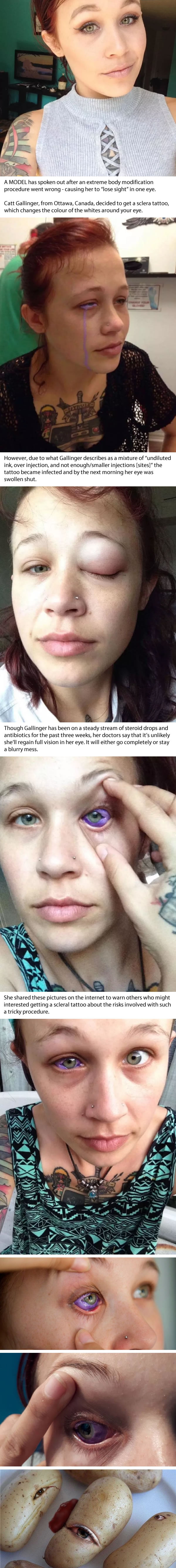 "Botched Eye Tattoo" Leaves This Girl Partially Blind, Now She's Trying To Warn Others