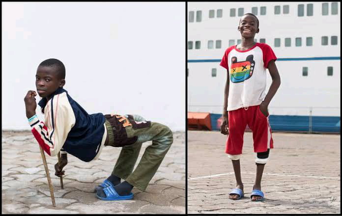 A Young boy named Ulrich before and after surgery to fix his backwards legs.