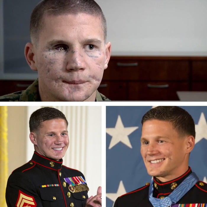 Medal Of Honor recipient Kyle Carpenter before and after facial reconstruction surgery.