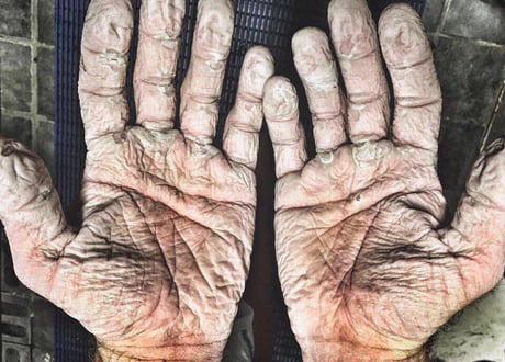 Two-time Olympic rowing champion Alex Gregory posted a photo of his hands after a 12-day rowing boat trip across the Arctic Ocean.