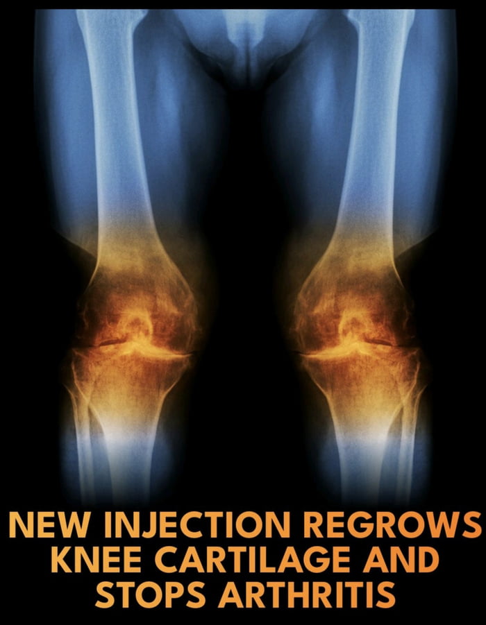 Knee pain will be a thing of the past