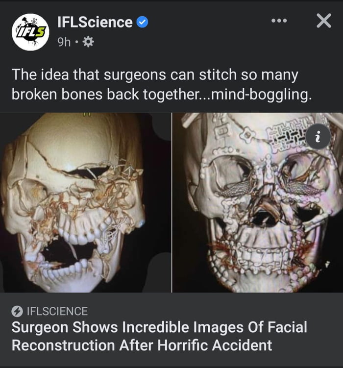 Mad props to the surgeon who basically reassembled a smashed face.