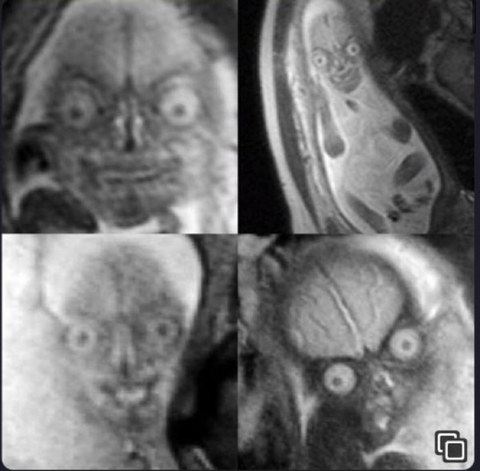 Mri Scan Of Baby In Mothers Womb 9gag