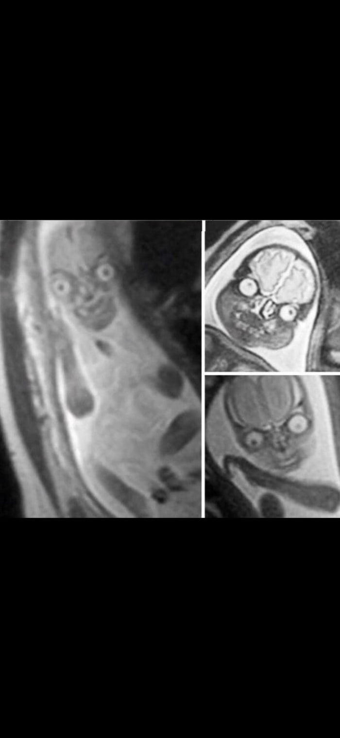 MRI of baby during pregnancy 9GAG