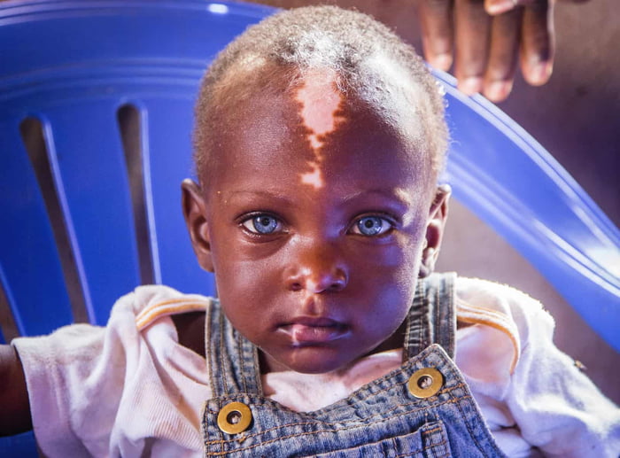 A child with Waardenburg Syndrome