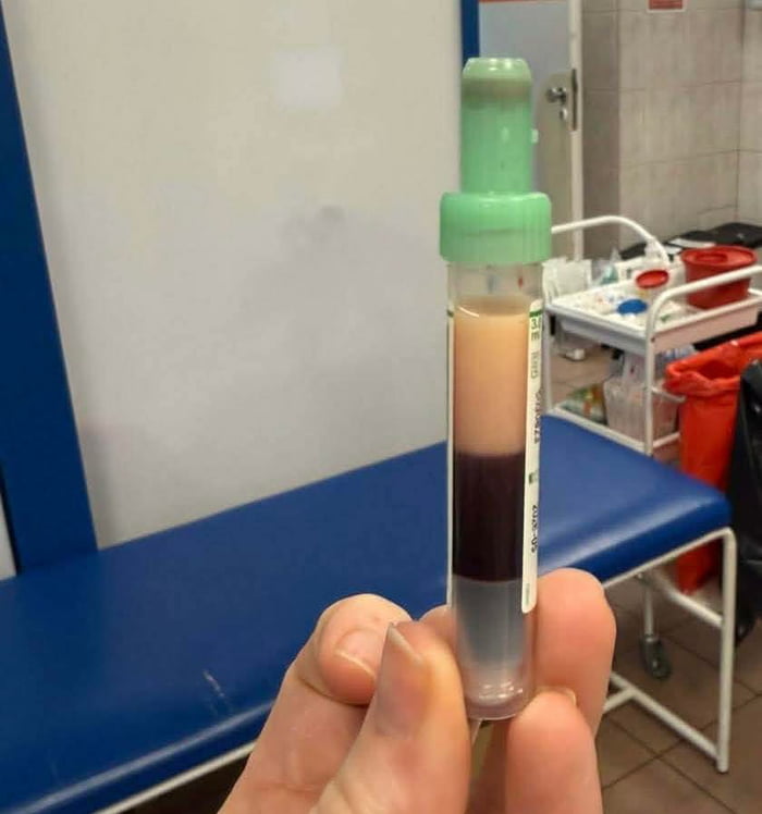 You know you're fat when your blood has fat