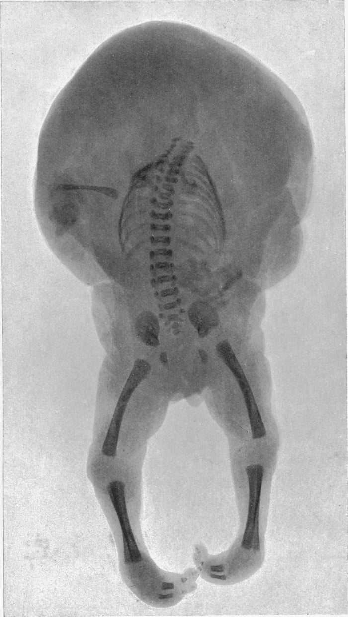 An X-Ray of human acardiac twin (a rare kind of parasitic twin that ...