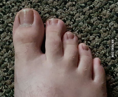 Anyone else's pinky toes rest sideways? - 9GAG