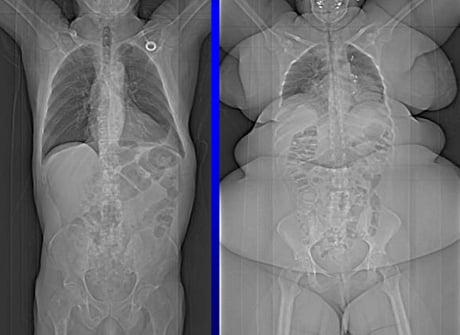 Yes, You Can Be 'Big Boned' (But That's Not Why You're Overweight)