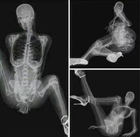 B*tch send nudes not your x-ray - 9GAG
