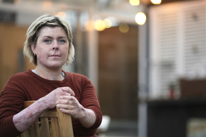 In 2019, a Swedish mother of 6, Emma Schols, saved all of her 6 children from her burning home, running from room to room through flames while bleeding & losing skin. Against all odds, she survived with extreme burns to over 90% of her body.