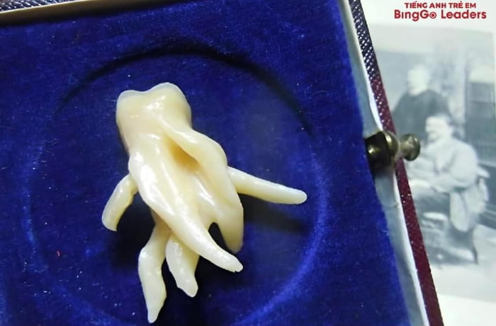 This wisdom tooth's root.