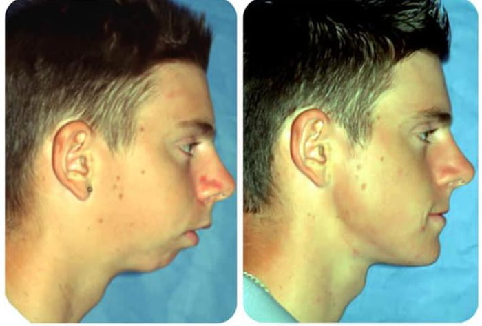 Incredible transformative power of jaw advancement surgery