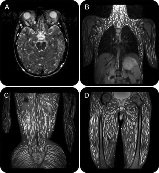 person-infected-with-worm-parasites-from-eating-raw-pork-9gag