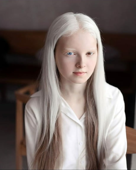 Hot White Albino Girls Telegraph