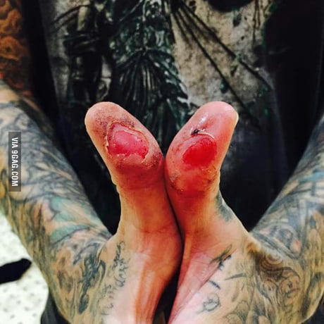 This is travis barker s thumbs after drumming for some night in a