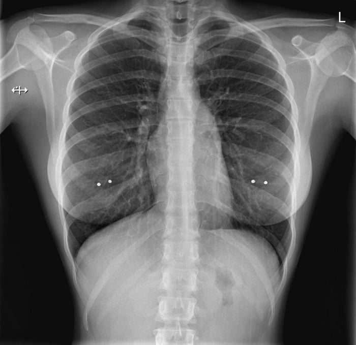 This chest X-ray 🩻 showing healthy lungs - 9GAG