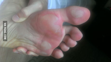 running barefoot on treadmill