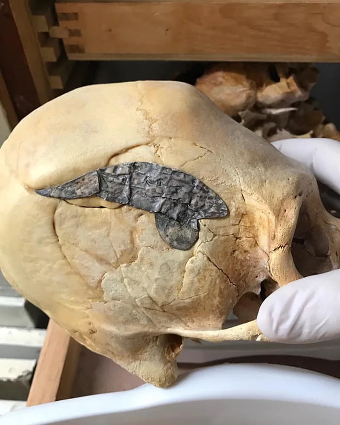 Cranioplasty in Ancient Peru. An elongated skull with metal surgically implanted after returning from battle, estimated to be from about 2000 years ago. The shattered bone that surrounds the repair has been tightly bonded together, indicating that the procedure was effective.
