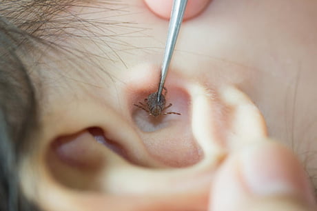 Graphic Doctor Finds Dog Tick Embedded In 9 Year Old Boy S Eardrum 9gag
