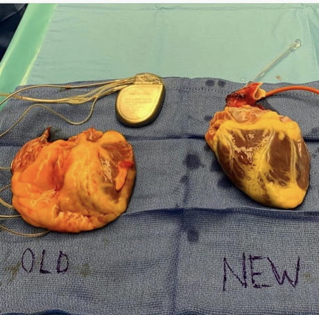 Heart transplant: a bad heart going out and a new heart going in.