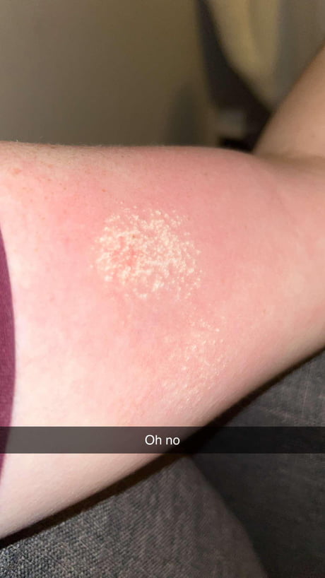 Added hydrogen peroxide to ringworm… why did it have this kind of 