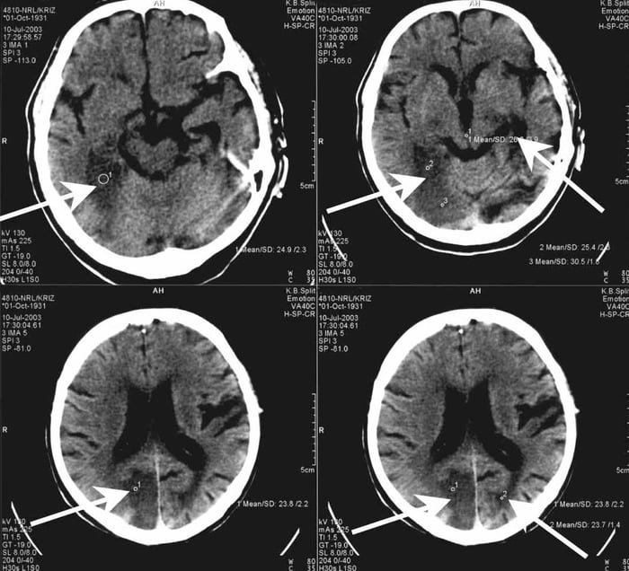 There is a very rare condition called Anton syndrome, in which a person becomes blind however they are unaware of it and will deny it, as their brain generates (false) visual images so they continue to believe that they can see