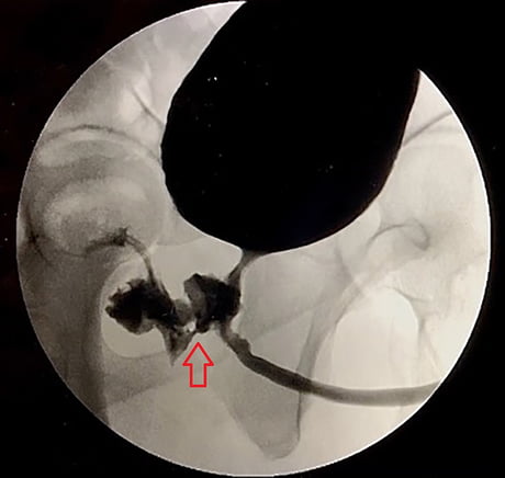 Man Poops Out Of Penis And Ejaculates Semen From Butt Due To Rare Condition - 9GAG