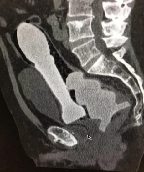 CT scan shows one small and one big rocket like sex toys stuck in