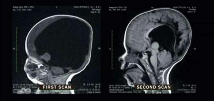 MRI scans of a boy born with only 2% of his brain and 2 years later. His brain regrew to 80% of its intended size and he only suffers from comparably small cognitive deficits today