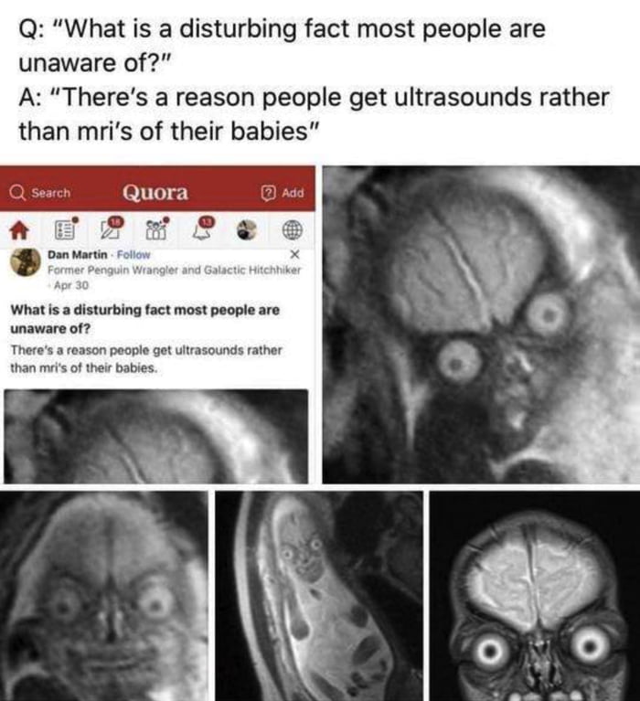 MRI's of babies 9GAG